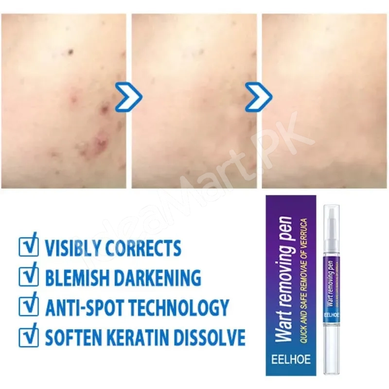 skin-tag-mole-remover-pen-remove-warts-pimples-black-dots-safely-for-women-product-image